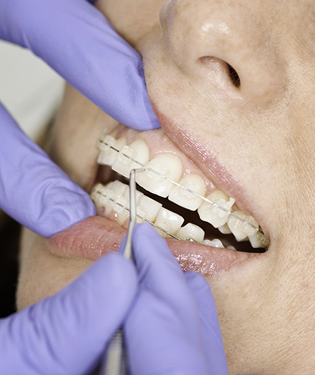 Why Do I Need Dental Cleanings in Santa Maria Image.