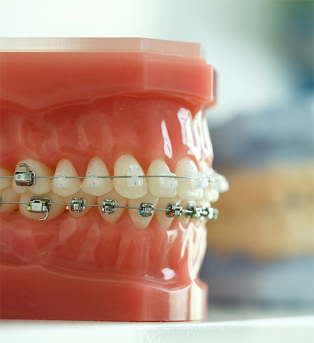 What Are the Benefits of Traditional Metal Braces at Santa Barbara Family Dentistry Image.