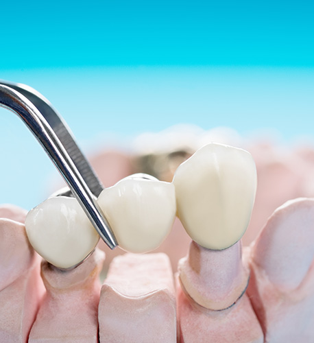  What Is the Difference Between a Dental Bridge and a Dental Implant from Santa Barbara Family Dentistry Image.