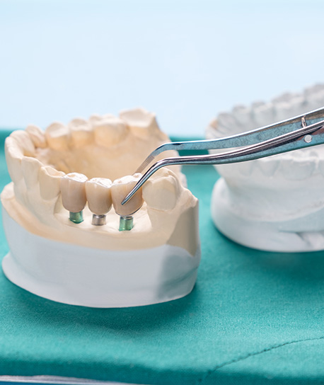  What Is the Difference Between a Dental Bridge and a Dental Implant in Santa Maria Image.