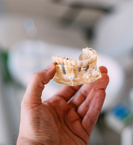 What Are Dental Implants at Santa Barbara Family Dentistry Image.