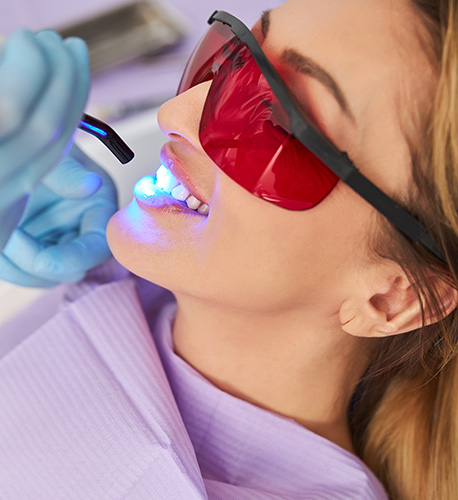 Why Choose Professional Teeth Whitening in Santa Maria Instead of OTC Options Image.